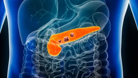 Emeli intellekt pankreatit keseliniň öňüni almak üçin öňünden alamatlary tapýar