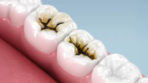 Ýönekeý suwuklyk çagalaryň diş çüýşmegini durduryp bilýär